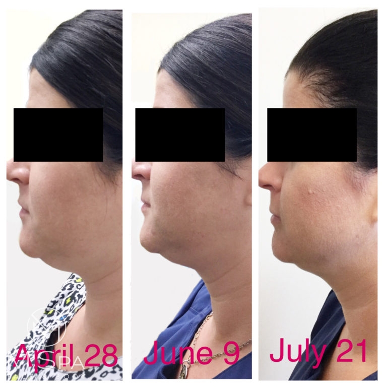Kybella Archives Medical Spa Houston & ster, TX M Spa Face and Body