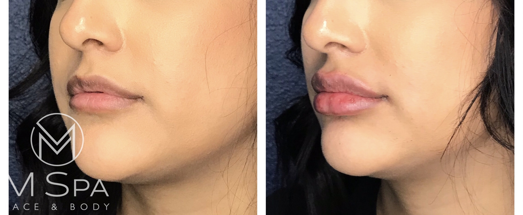 juvederm1995 Medical Spa Houston & ster, TX M Spa Face and Body