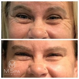 dysport crows feet treatment before and after