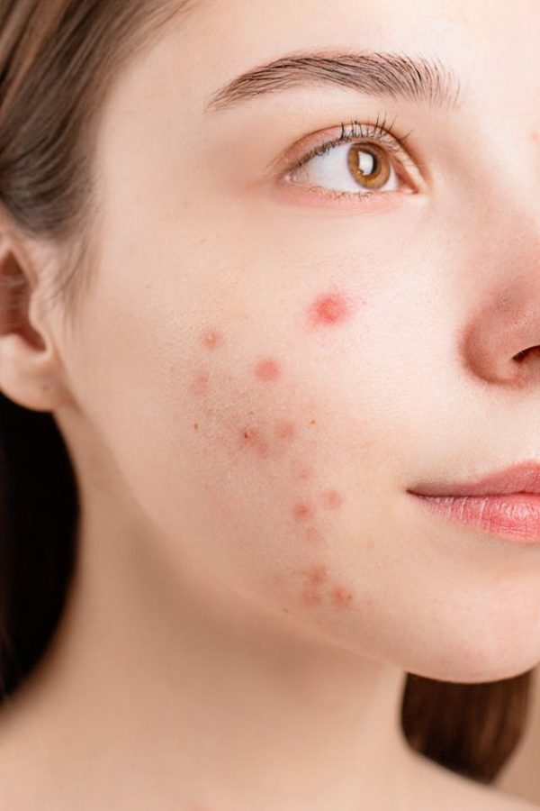 What Is the Best Acne Treatment? M Spa Face & Body